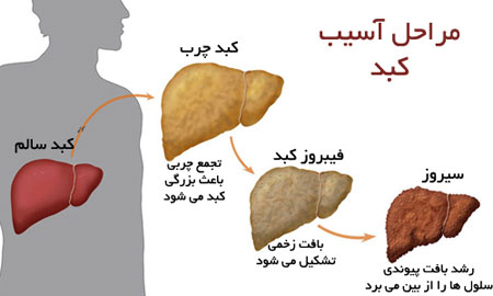 توصيه هاي تغذيه اي مناسب براي افراد مبتلا به کبد چرب: