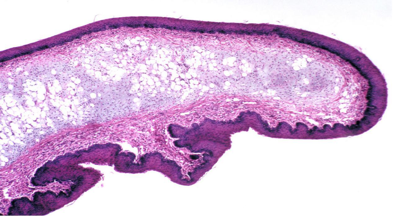  اپیگلوت (به انگلیسی: Epiglottis) یا بَرچاک‌نای زبانه‌ای است که بالای حنجره قرار دارد و مانع ورود غذا به نای می‌شود.برچاک‌نای پرده‌ای است که از بافت غضروفی انعطاف‌پذیر و پوشیده‌شده با غشای لعاب‌مانند تشکیل می‌شود و به ورودی حنجره متصل است. این پرده در تولید برخی آواهای زبانی در برخی زبان‌ها مانند عربی نقش دارد.برچاک‌نای به صورت مایل به پشت در انتهای خلفی زبان و پشت استخوان لامی قرار دارد و در معاینه داخل حلق اغلب به سختی قابل مشاهده است. اپیگلوت هنگام بلع غذا مانع ورود آن به نای می‌شود.