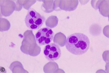  نوتروفیل یا خنثی‌خواه (به انگلیسی: Neutrophil) نوعی گویچهٔ سفید بیگانه‌خوار است. نوتروفیل‌ها دارای کموتاکسی (شیمی‌رَوی) هستند و در دستگاه ایمنی بدن انسان، در خط دوم دفاع غیراختصاصی قرار دارند.نوتروفیل‌های گلبول‌های سفید کروی شکلی هستند. این گلبول‌ها ۱۲ تا ۱۸ میکرون قطر دارند. عمر نوتروفیل‌ها حدود ۶ ساعت تا چند روز است. نوتروفیلها بیش از ۶۰٪ گلبول‌های سفید خون را تشکیل می‌دهند ودارای هسته لبوله (چند لوبه) می‌باشند، توانائی بیگانه خواری (فاگوسیتوز) دارند. وضعیت هسته بسیار متراکم و کناری بوده و در وسط آن فرورفتگی وجود دارد و تا نصف قطر سلول می‌رسد. دارای سیتوپلاسم وسیع می‌باشند و نسبت هسته به سیتوپلاسم مساوی است. گرانول‌های نوتروفیلی ظریف و صورتی رنگ، اندازه آن‌ها متغیر، تقریباً همه آن‌ها ثانویه‌اند. گرانول‌های اولیه عمدتاً گرد و قطر ۵۰۰ نانومتری دارند. از مرحله متامایلوسیت به نسبت گرانول‌های اولیه به ثانویه حدود ۱ به ۲ می‌باشد. نوتروفیل‌ها دستگاه گلژی کوچکی دارند.[۱] نوتروفیلها در عفونت‌های حاد مانند بیماریهای عفونی و آپاندیسیت حاد در خون افزایش می‌یابند. نوتروفیل‌ها و مونوسیت‌ها گویچه‌های سفیدی هستند که توانایی تراگذری (دیاپدز) را دارند.