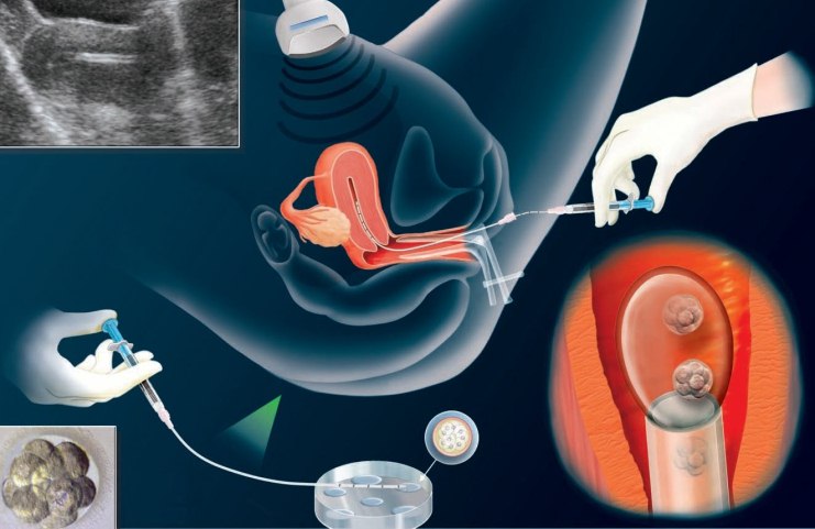 همه چیز درمورد IVF