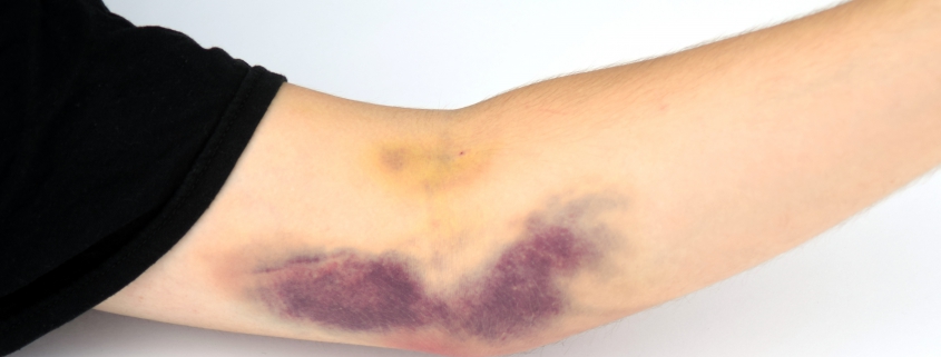 دلایلی که می تواند منجر به کبودی محل خونگیری گردد