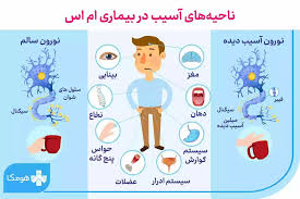 نحوه تشخیص ام اس چگونه است؟